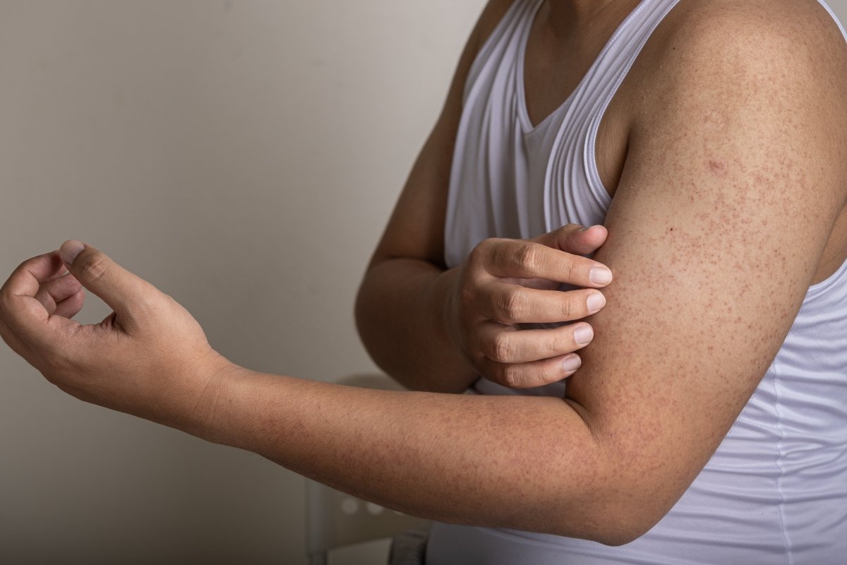 can glutathione help keratosis pilaris What is Pilaris? How to Combat Keratosis Pilaris
